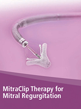 The MitraClip Therapy for Mitral Regurgitation