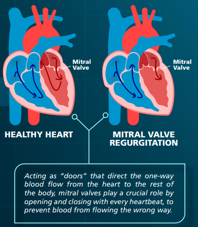 ​A New Pathway In Mitral Valve Heart Surgery