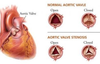 Aortic Valve Surgery.jpg