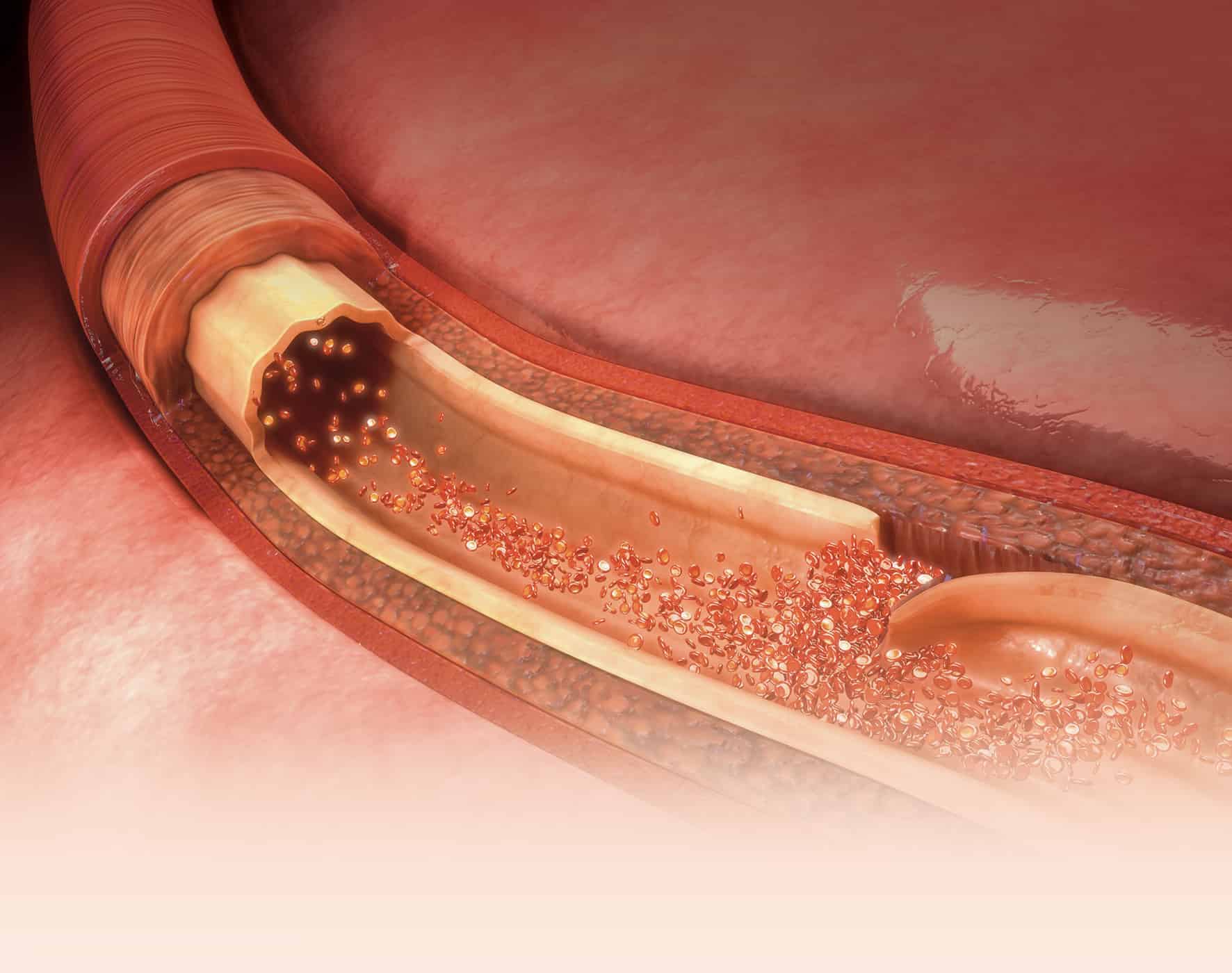 Rendered image of an artery