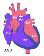 Congenital Heart Disease in Children (CHD) - NUHCS | National
