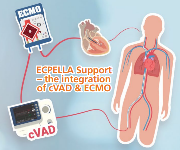 Ecpella Support Image