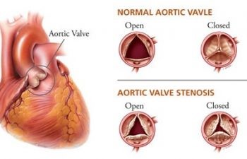 Minimally Invasive Cardiac Surgery Programme - NUHCS